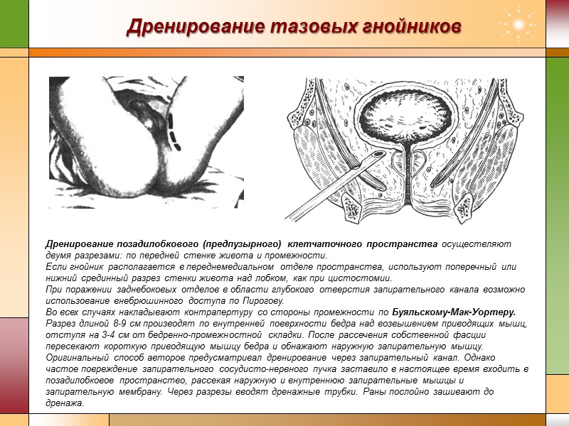 Дренирование тазовых гнойников Дренирование позадилобкового (предпузырного) клетчаточного пространства осуществляют двумя разрезами: по передней стенке